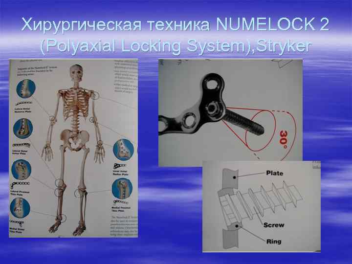 Хирургическая техника NUMELOCK 2 (Polyaxial Locking System), Stryker 