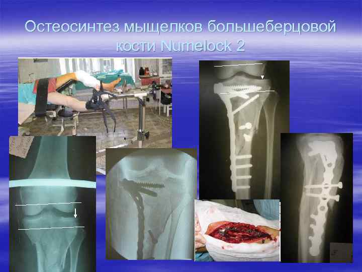 Остеосинтез мыщелков большеберцовой кости Numelock 2 