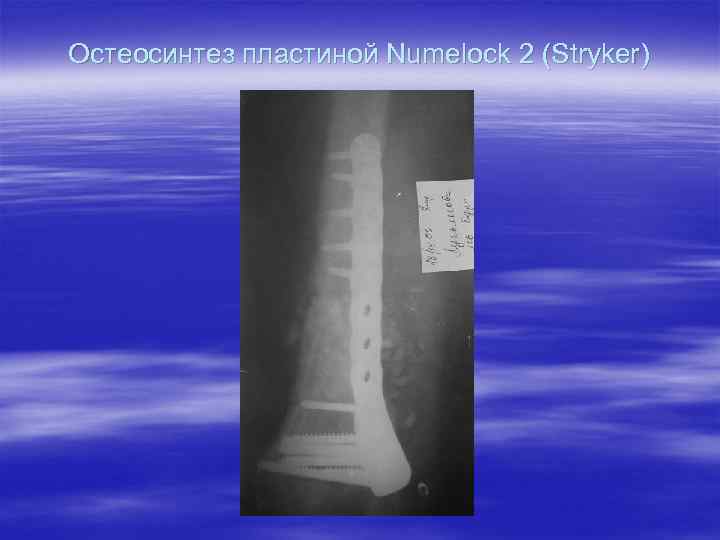 Остеосинтез пластиной Numelock 2 (Stryker) 