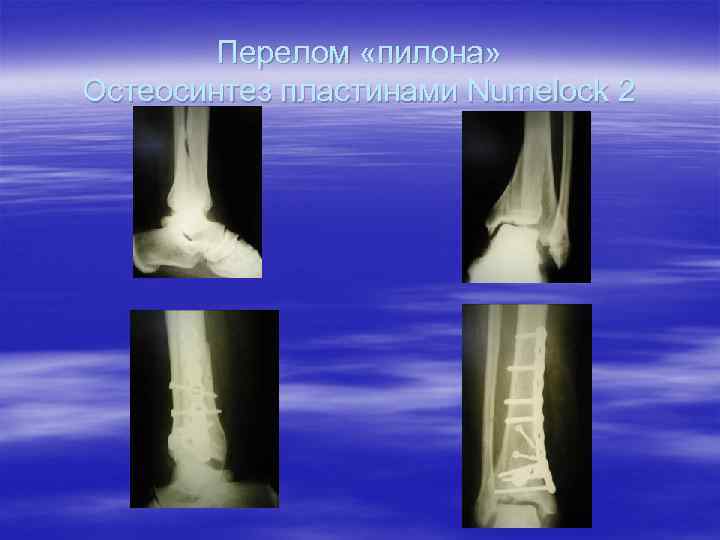 Перелом «пилона» Остеосинтез пластинами Numelock 2 