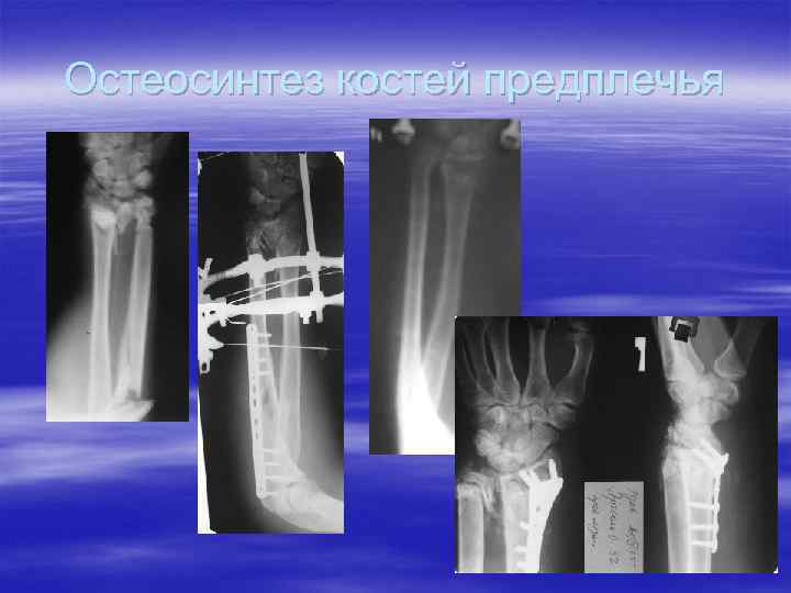 Остеосинтез костей предплечья 