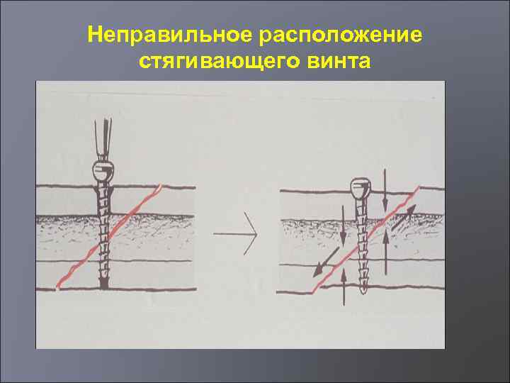 Неправильное расположение стягивающего винта 