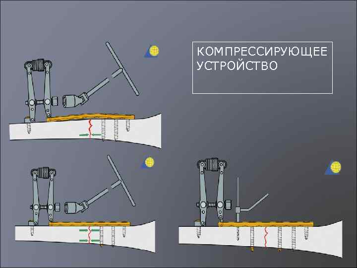 КОМПРЕССИРУЮЩЕЕ УСТРОЙСТВО 