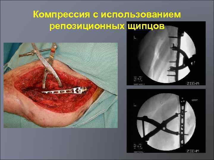 Компрессия с использованием репозиционных щипцов 