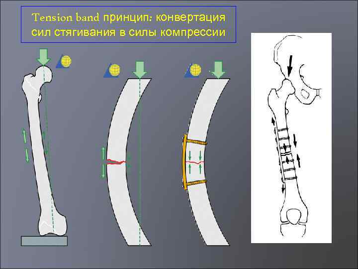 Tension band принцип: конвертация сил стягивания в силы компрессии 