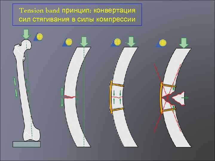 Tension band принцип: конвертация сил стягивания в силы компрессии 