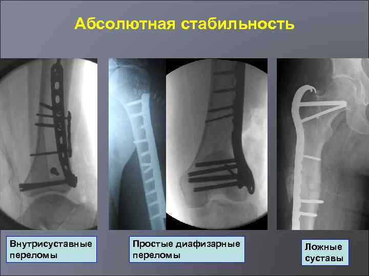 Абсолютная стабильность Внутрисуставные переломы Простые диафизарные переломы Ложные суставы 