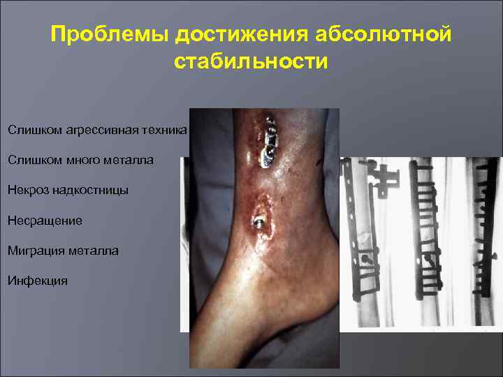Проблемы достижения абсолютной стабильности Слишком агрессивная техника Слишком много металла Некроз надкостницы Несращение Миграция