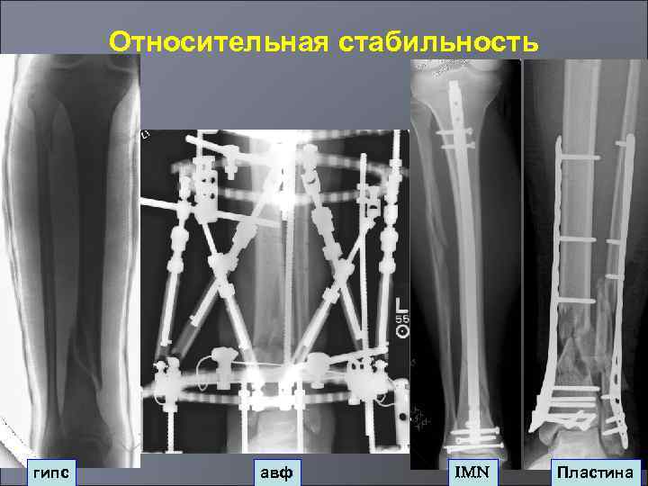 Относительная стабильность гипс авф IMN Пластина 