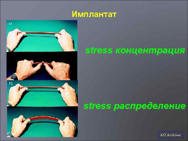 Имплантат stress концентрация stress распределение AO Archives 