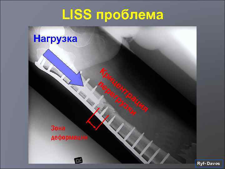 LISS проблема Нагрузка Кр нц пе е ре нт гр ра уз ци ки