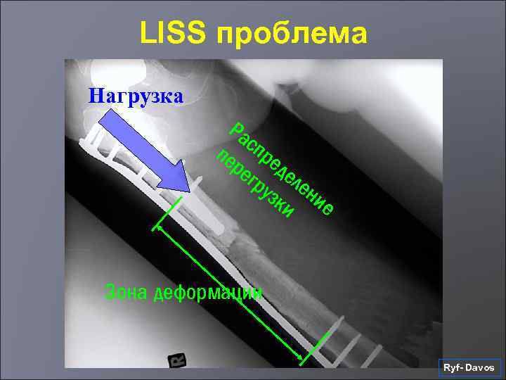 LISS проблема Нагрузка Ра сп пе ре ре де гр ле узк ни и