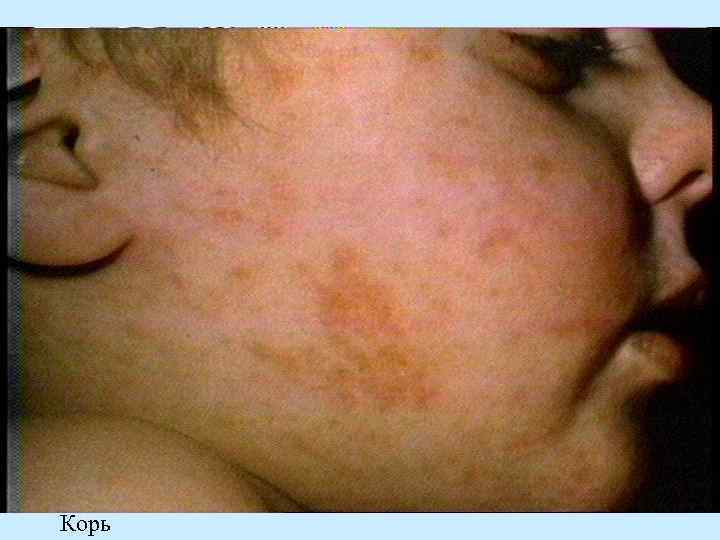 Корь 