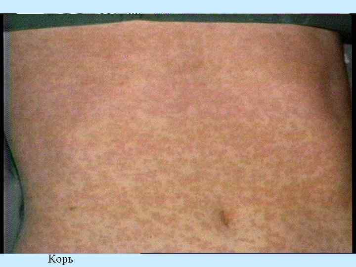 Корь 