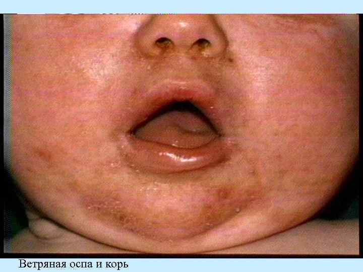 Ветряная оспа и корь 