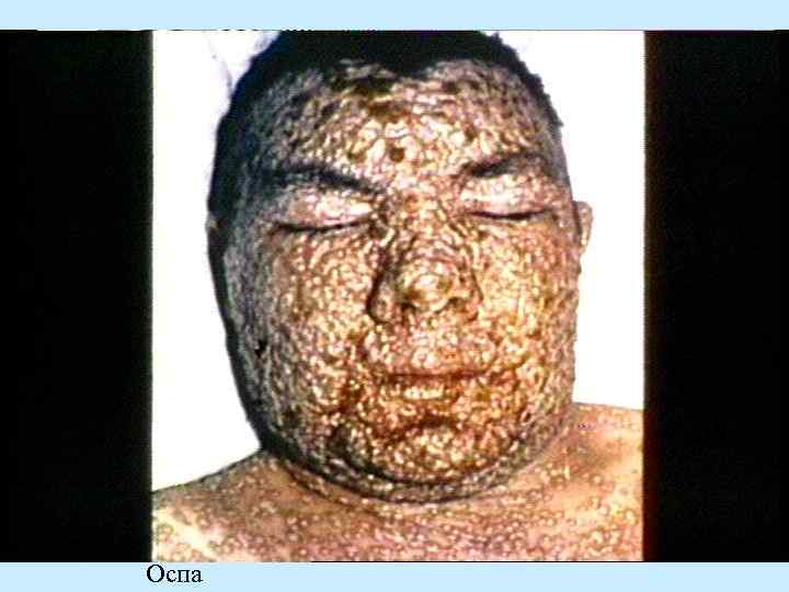 Оспа 