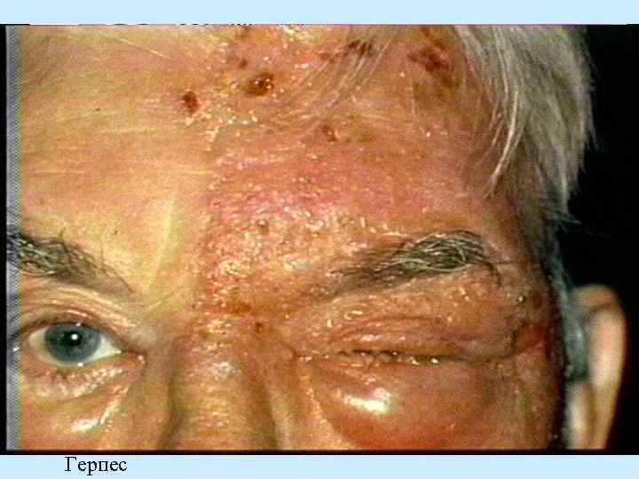 Герпес 