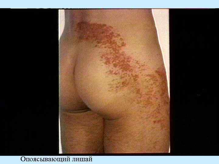 Опоясывающий лишай 