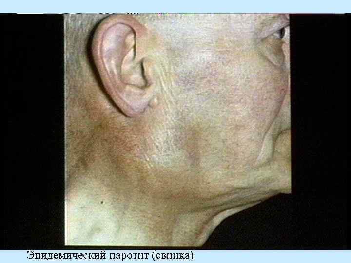 Эпидемический паротит (свинка) 