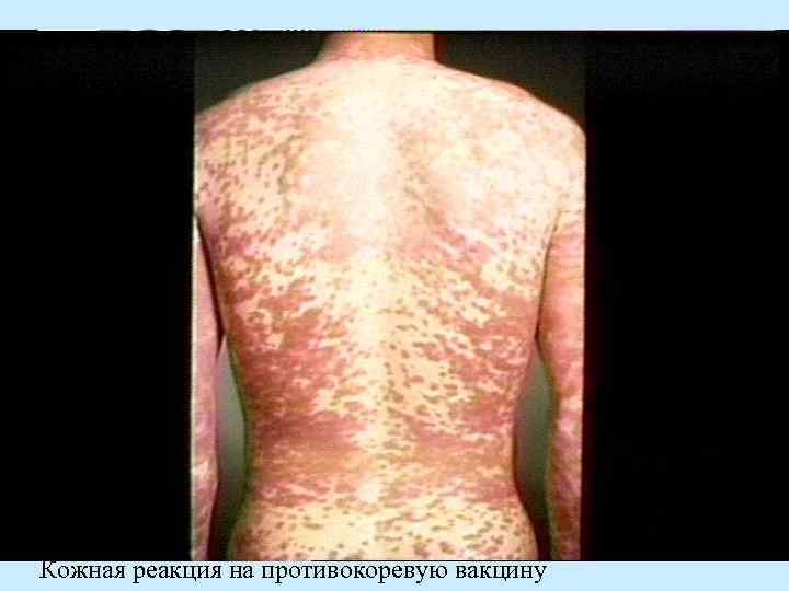 Кожная реакция на противокоревую вакцину 