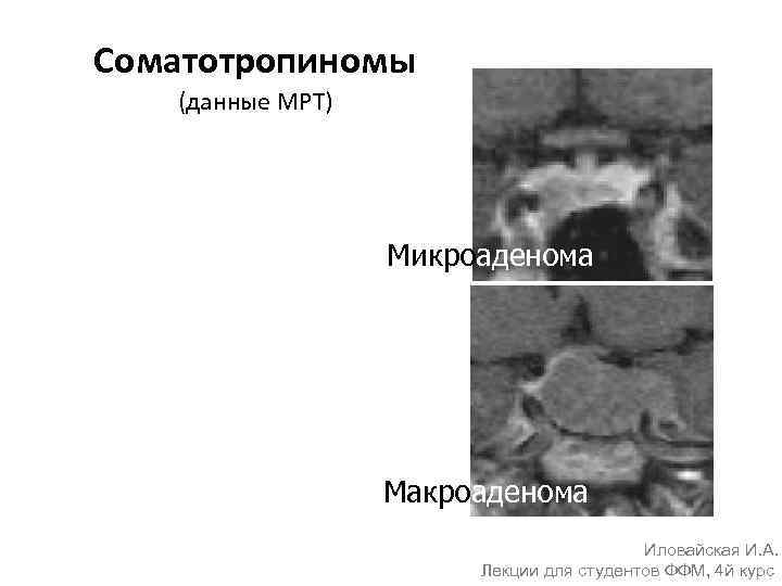 Соматотропиномы (данные МРТ) Микроаденома Макроаденома Иловайская И. А. Лекции для студентов ФФМ, 4 й