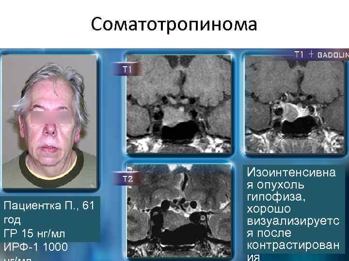 Соматотропинома Пациентка П. , 61 год ГР 15 нг/мл ИРФ-1 1000 Изоинтенсивна я опухоль