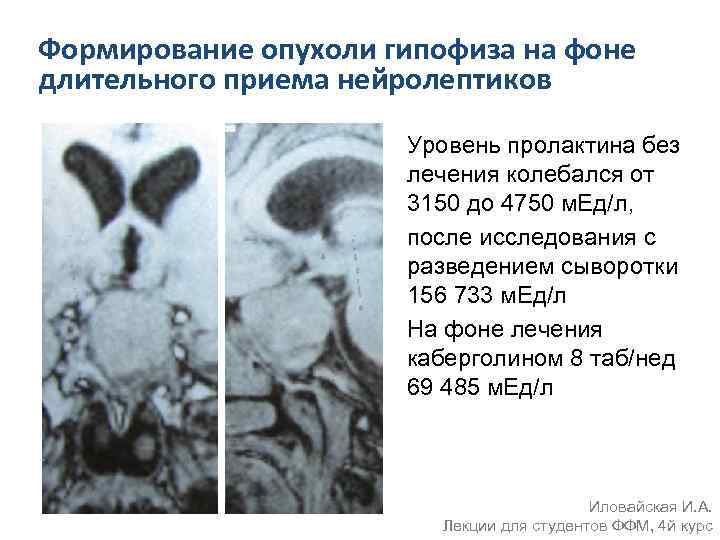 Формирование опухоли гипофиза на фоне длительного приема нейролептиков Уровень пролактина без лечения колебался от