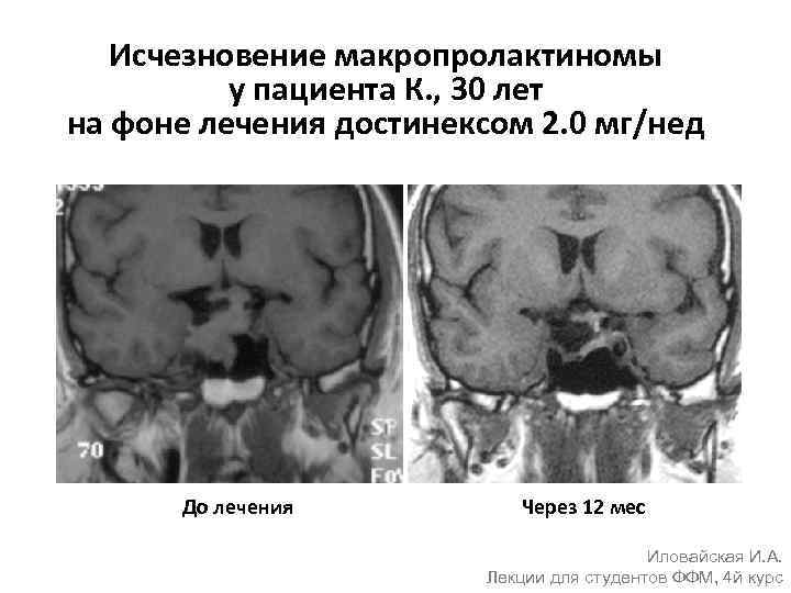 Исчезновение макропролактиномы у пациента К. , 30 лет на фоне лечения достинексом 2. 0
