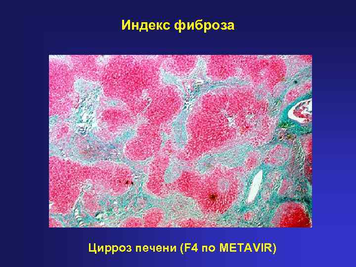 Фиброз тканей. Фиброз 4 по метавир фиброза печени. Индекс фиброза. Цирроз печени f4 по шкале metavir. Фиброз печени по шкале metavir f4.2.