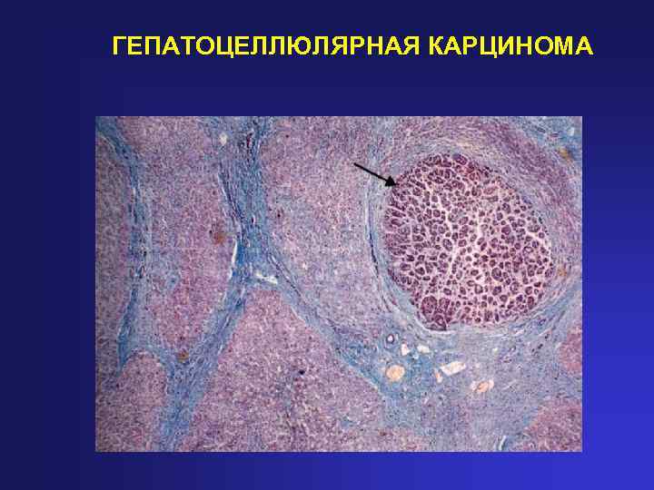 Гепатоцеллюлярный рак презентация