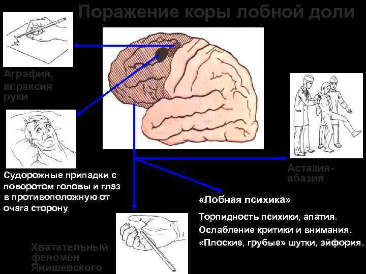 Поражение коры. Поражение префронтальной коры лобной доли. Апраксия поражение коры. Локализации поражения при апраксии. Симптомы поражения лобной доли неврология.