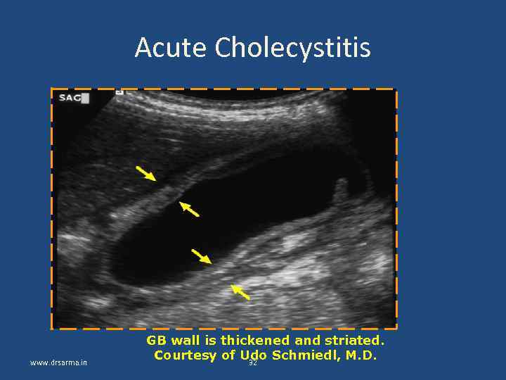 Acute Cholecystitis www. drsarma. in GB wall is thickened and striated. Courtesy of Udo