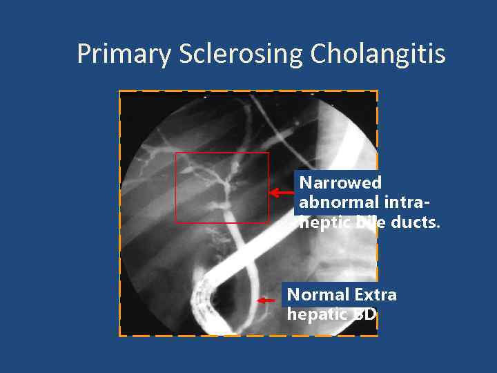 Primary Sclerosing Cholangitis Narrowed abnormal intraheptic bile ducts. Normal Extra hepatic BD 