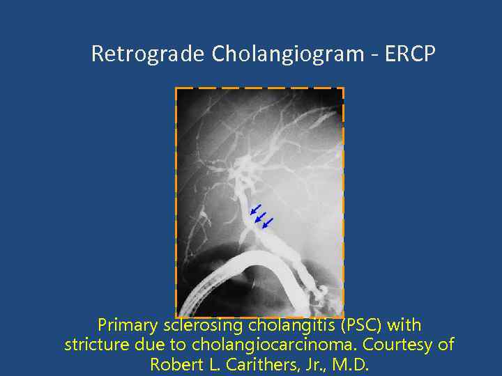 Retrograde Cholangiogram - ERCP Primary sclerosing cholangitis (PSC) with stricture due to cholangiocarcinoma. Courtesy