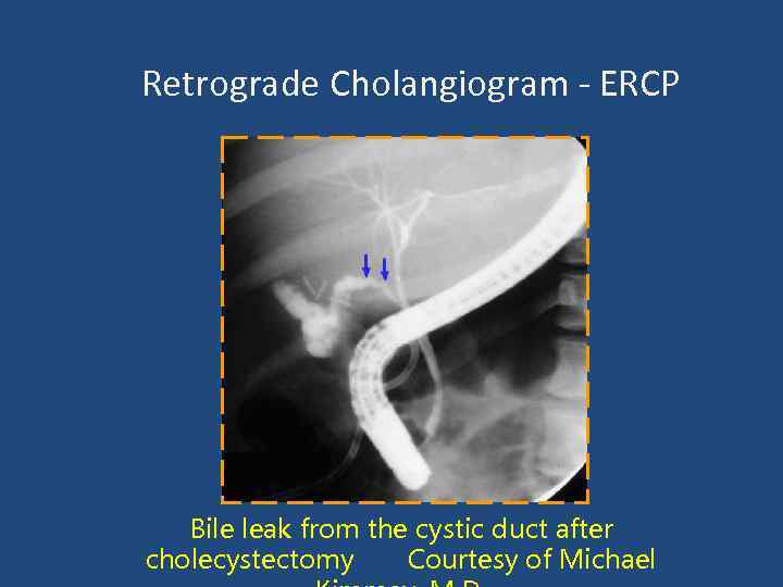 Retrograde Cholangiogram - ERCP Bile leak from the cystic duct after cholecystectomy Courtesy of