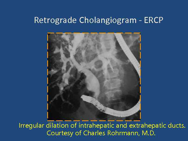 Retrograde Cholangiogram - ERCP Irregular dilation of intrahepatic and extrahepatic ducts. Courtesy of Charles