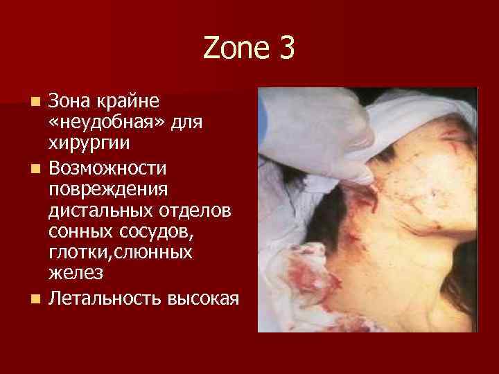 Zone 3 Зона крайне «неудобная» для хирургии n Возможности повреждения дистальных отделов сонных сосудов,