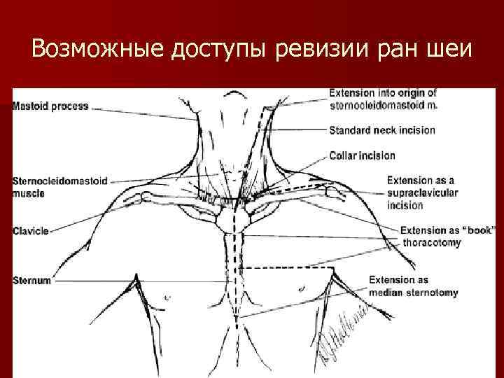 Возможные доступы ревизии ран шеи 