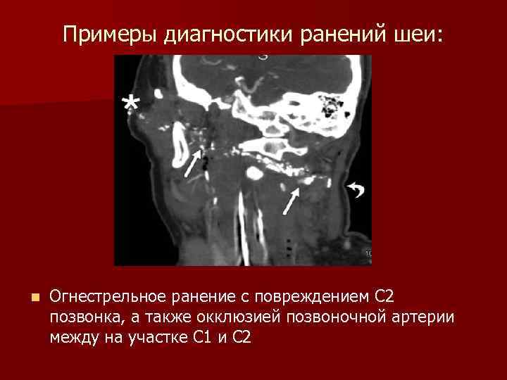 Примеры диагностики ранений шеи: n Огнестрельное ранение с повреждением C 2 позвонка, а также