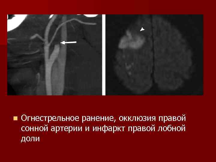 n Огнестрельное ранение, окклюзия правой сонной артерии и инфаркт правой лобной доли 