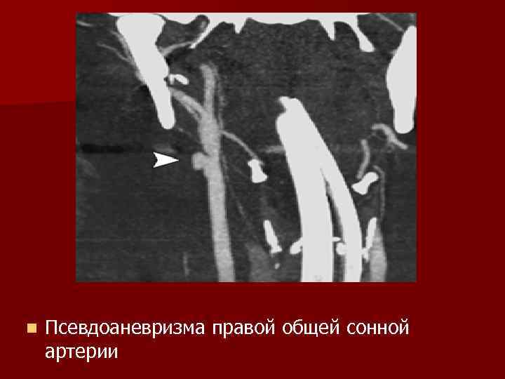 n Псевдоаневризма правой общей сонной артерии 