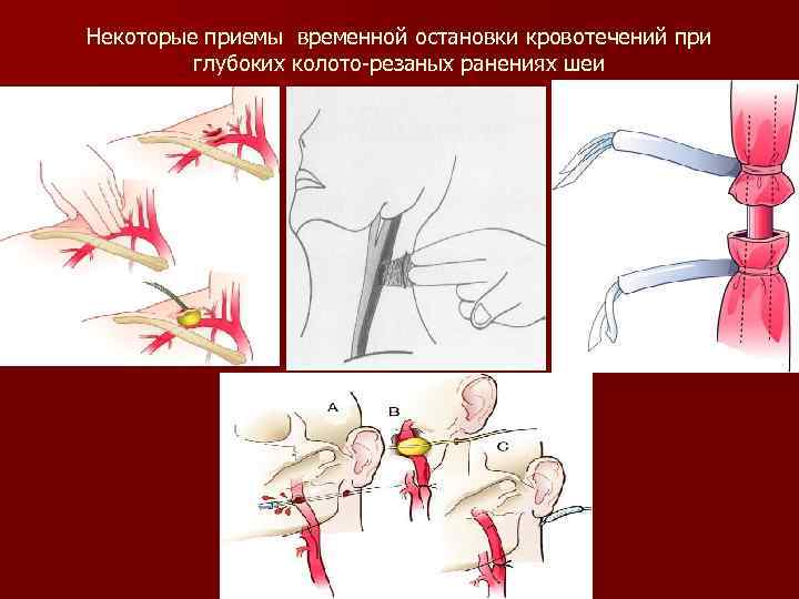 Некоторые приемы временной остановки кровотечений при глубоких колото-резаных ранениях шеи 