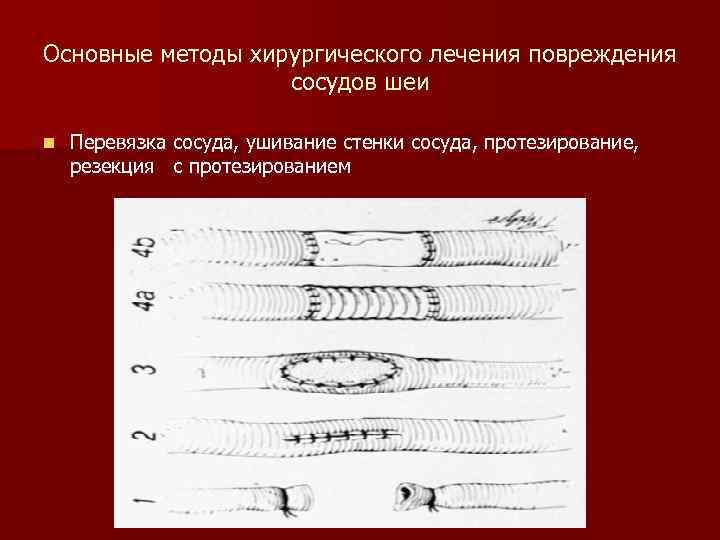 Основные методы хирургического лечения повреждения сосудов шеи n Перевязка сосуда, ушивание стенки сосуда, протезирование,