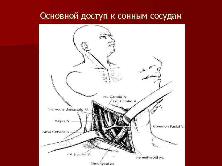 Основной доступ к сонным сосудам 
