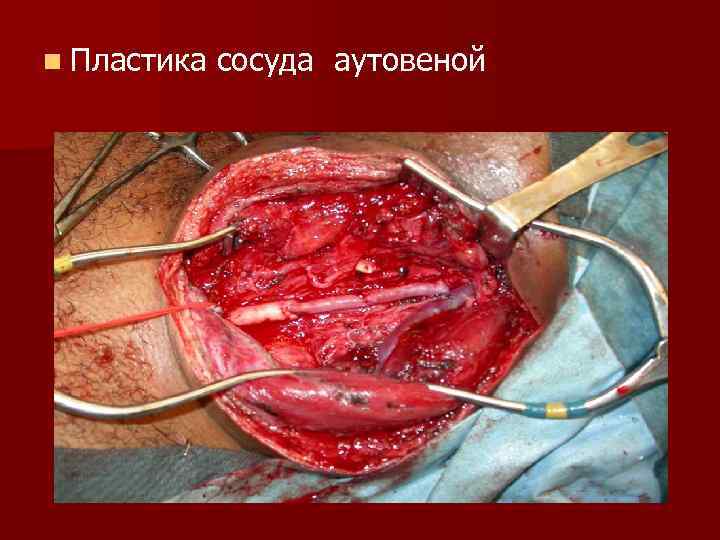 n Пластика сосуда аутовеной 