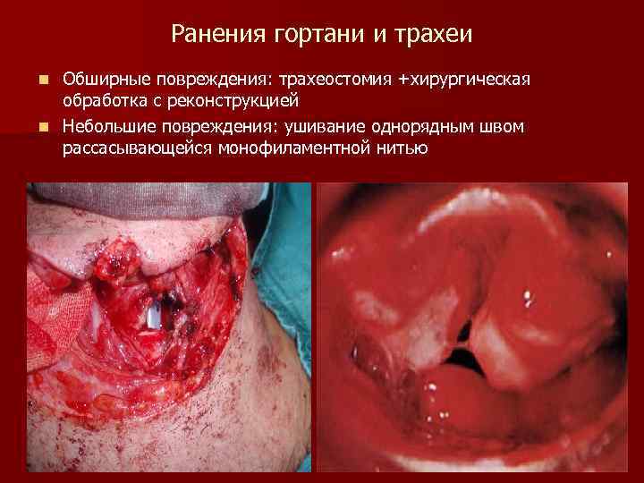 Ранения гортани и трахеи Обширные повреждения: трахеостомия +хирургическая обработка с реконструкцией n Небольшие повреждения: