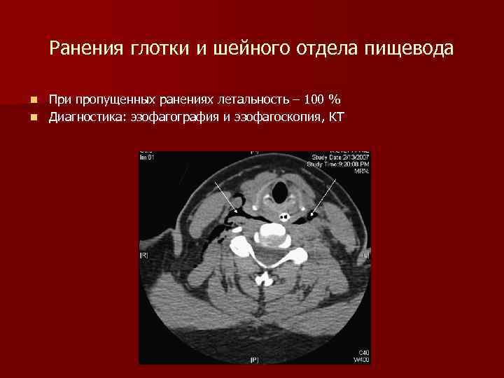 Ранения глотки и шейного отдела пищевода При пропущенных ранениях летальность – 100 % n
