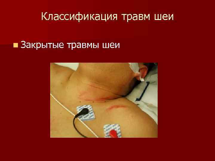 Классификация травм шеи n Закрытые травмы шеи 