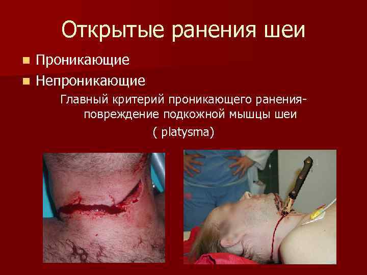 Открытые ранения шеи Проникающие n Непроникающие n Главный критерий проникающего раненияповреждение подкожной мышцы шеи