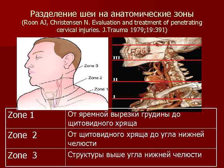 Разделение шеи на анатомические зоны (Roon AJ, Christensen N. Evaluation and treatment of penetrating